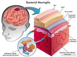 bacterial-meningitis-