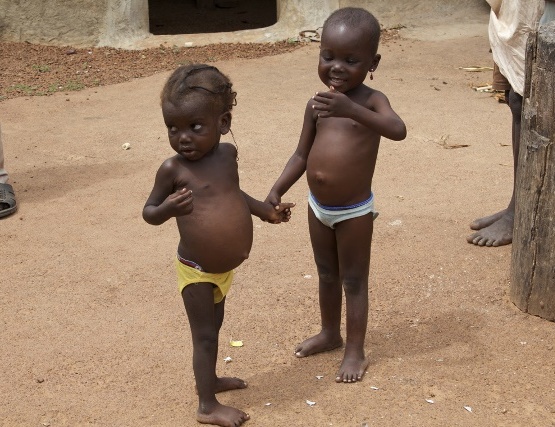 Malnutrition high among children at East Gonja District