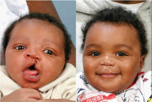 NGO performs free cleft and palate surgeries for 155