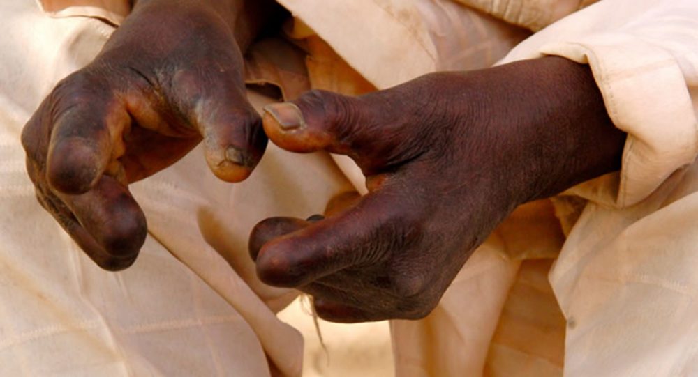Ghana intensifies measures to eliminate leprosy