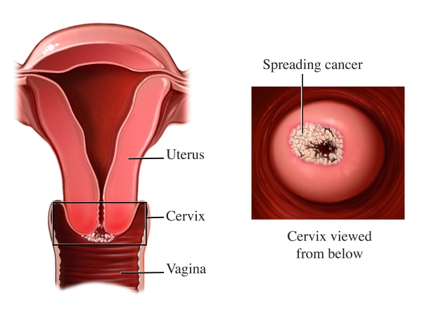 Ghana losing too many young women to cervical cancer